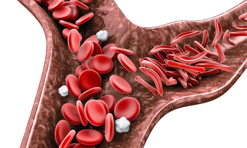 LA ANEMIA FALCIFORME ES CURABLE SI SE DETECTA A TIEMPO: IMSS